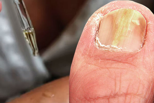 Aceite de orégano para HONGOS en las UÑAS