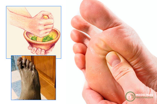 Neuroma de Morton dolor y ardor en los pies