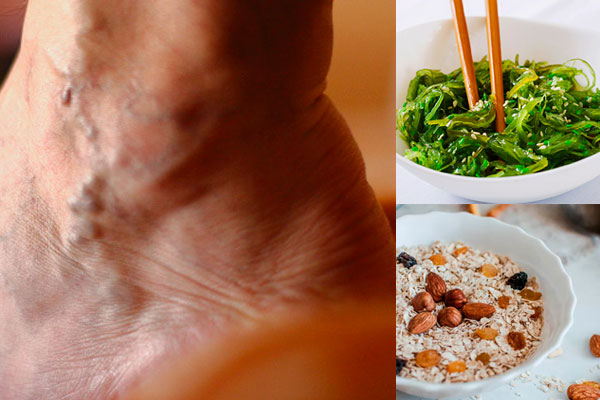 Dieta para pacientes con varices