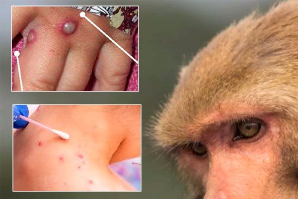 Viruela del mono alerta sanitaria mundial 2022