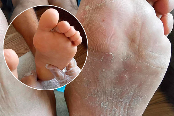 Pies maltratados, secos y agrietados