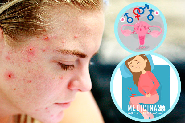 Acné hormonal por presencia de quistes y desordenes hormonales