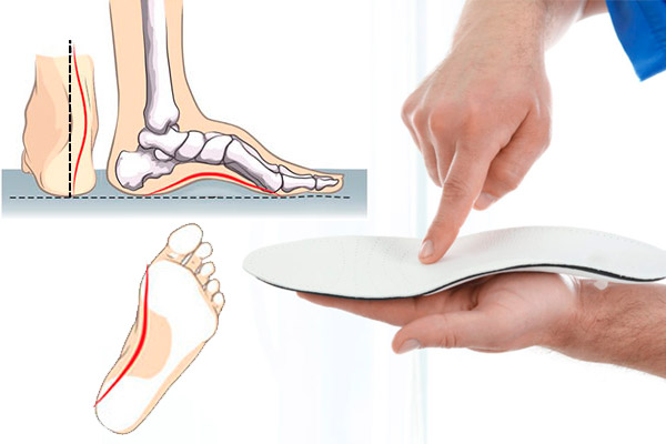 PIE CAVO: Dolor, terapias y recomendaciones