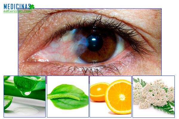 Pterigion, como eliminar la carnosidad en los ojos