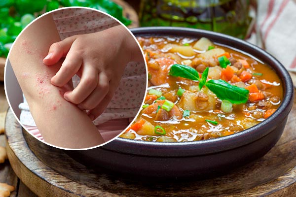 Dermatitis atópica (Eccemas) recetas saludables