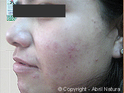 Acne comedoniano