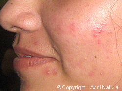 acne comedoniano