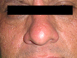 Acne comedoniano