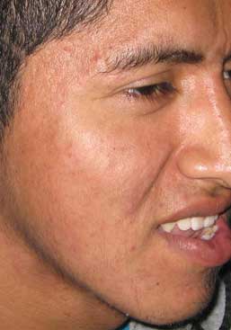 [Imagen: acne_curado.jpg]