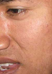 acne curado