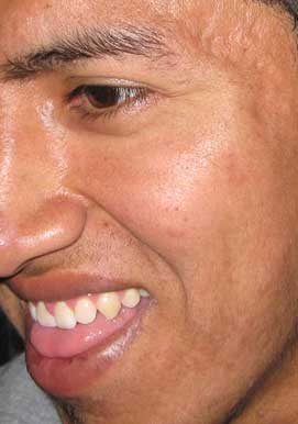 How To Get Rid Of Acne On Back Apps Directories
