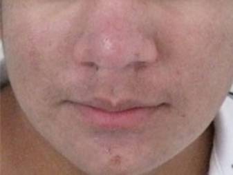 Acne 