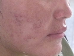 Acne 