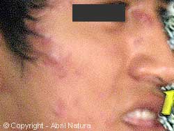 [Imagen: quistico_nodular1c.jpg]