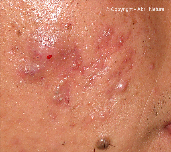 Acne quistico