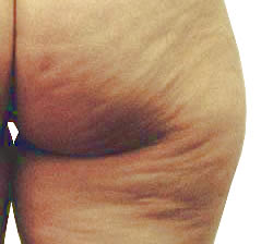 Celulitis