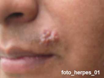 herpes foto tratamiento natural