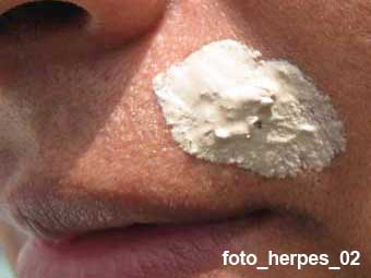 herpes se cura con uña de gato arcilla y llanten