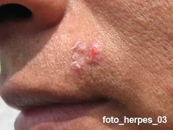 herpes resultado de tratamiento
