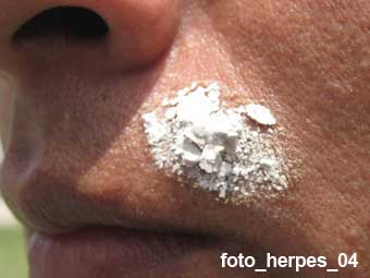 herpes tratamiento
