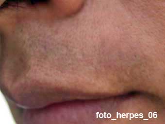 herpes curado con tratamiento natural