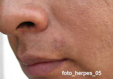 herpes curado