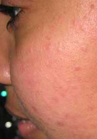 acne nodular