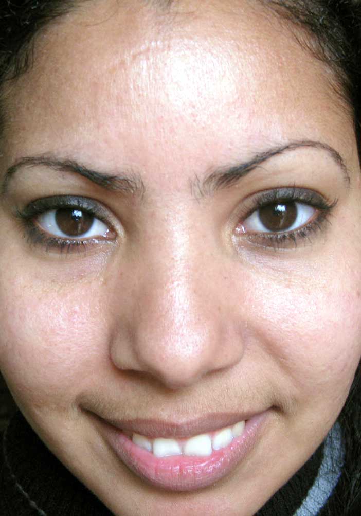 acne curado
