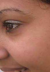 acne curado