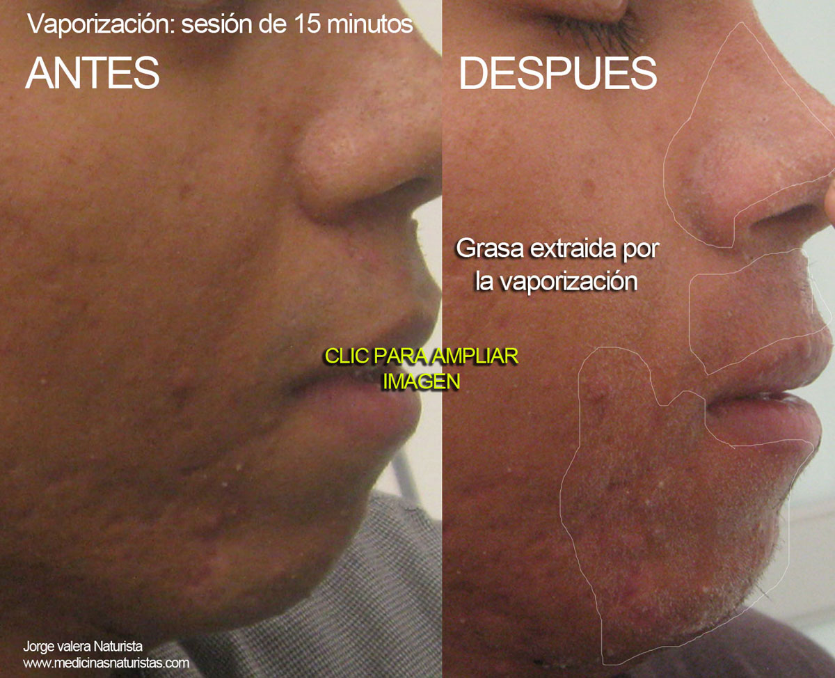 acne vaporizacion