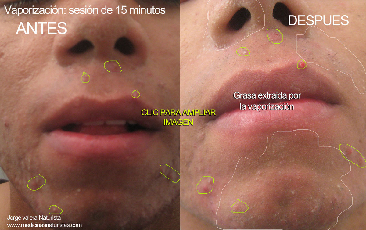 acne vaportizacion 