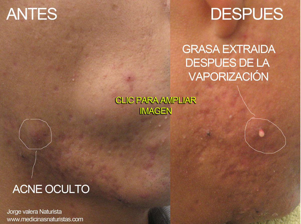 vaporizacion tratamiento para el acne