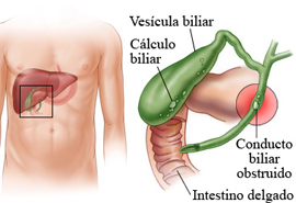 calculos biliares
