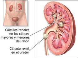 calculos biliares
