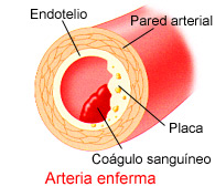 coagulo sanguineo