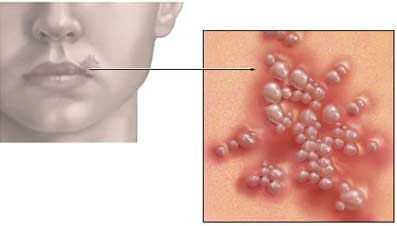 Herpes