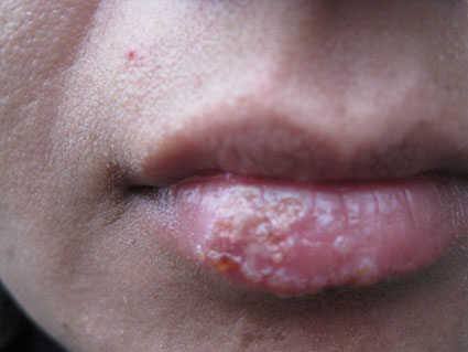 herpes tratamiento