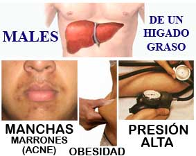 Higado graso males