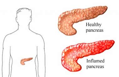 Enfermedades tercera edad PANCREATITIS remedios caseros y Enfermedades tercera edad PANCREATITIS remedios caseros y