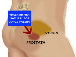prostatitis