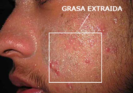 grasa de acne