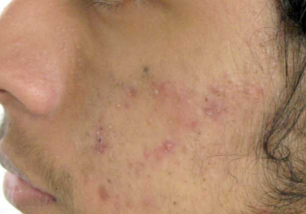 acne mejorado 1
