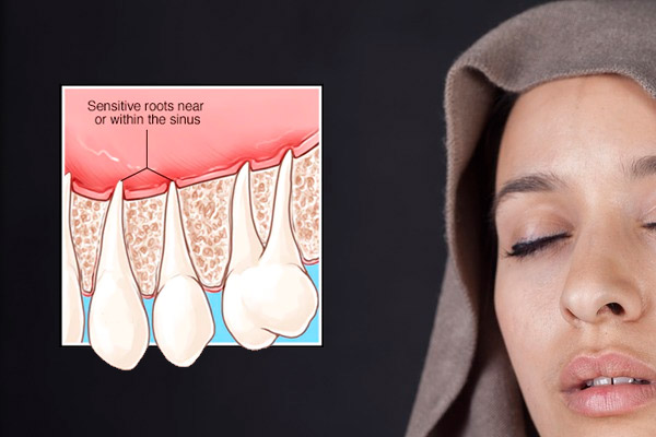 Sinusitis maxilar por lesiones dentales
